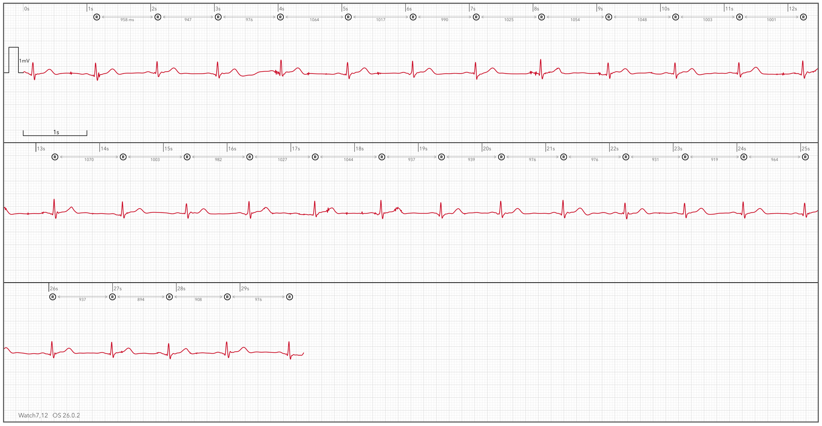 ECG strip from an Apple Watch Ultra 3, interpreted by the ECG+ app, used for the inter-beat interval calculations below